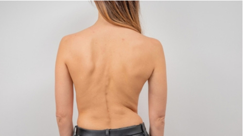Deerfield Beach scoliosis treatment concept woman with curved spine