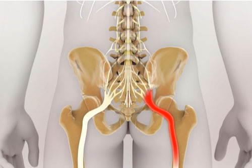 North Lauderdale sciatica treatment concept illustration of sciatic nerve