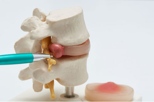 Fort Lauderdale herniated disc treatment concept, model of spinal disc